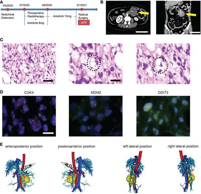 Case report: Pathological complete response to perioperative treatment of radiotherapy combined with angiogenesis inhibitor in a patient with pleomorphic liposarcoma